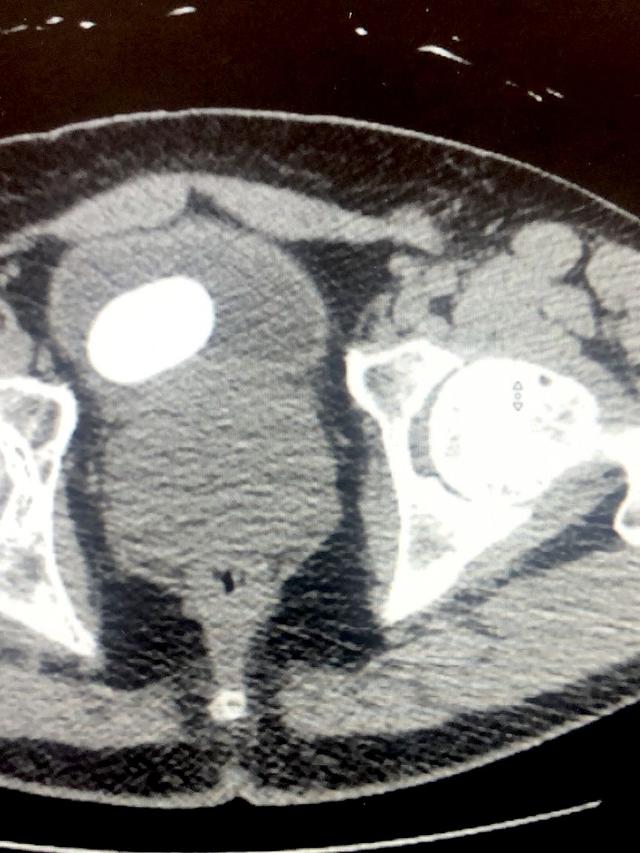 Recognizing Bladder Stones